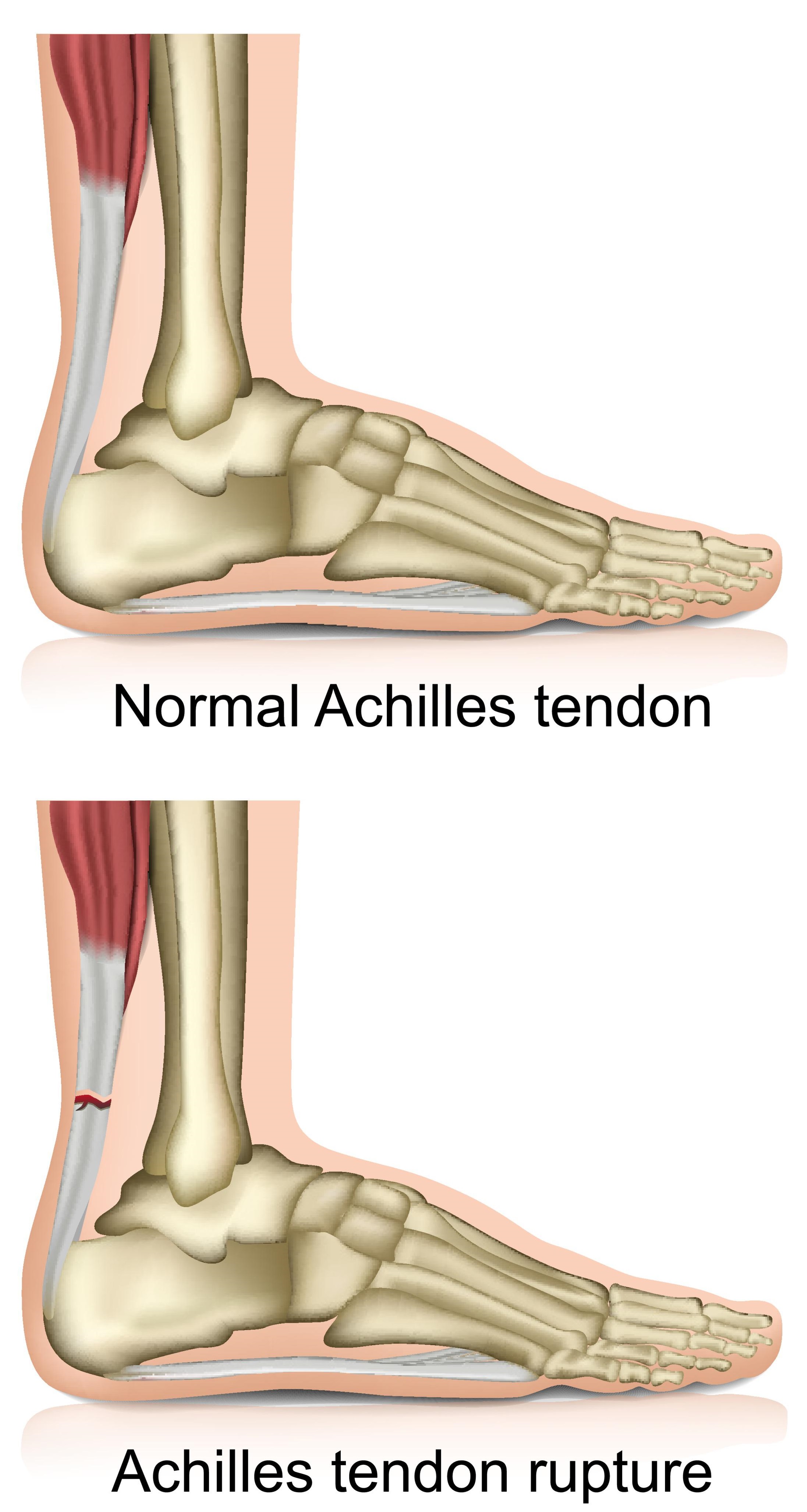 achilles tendon sore after sleeping