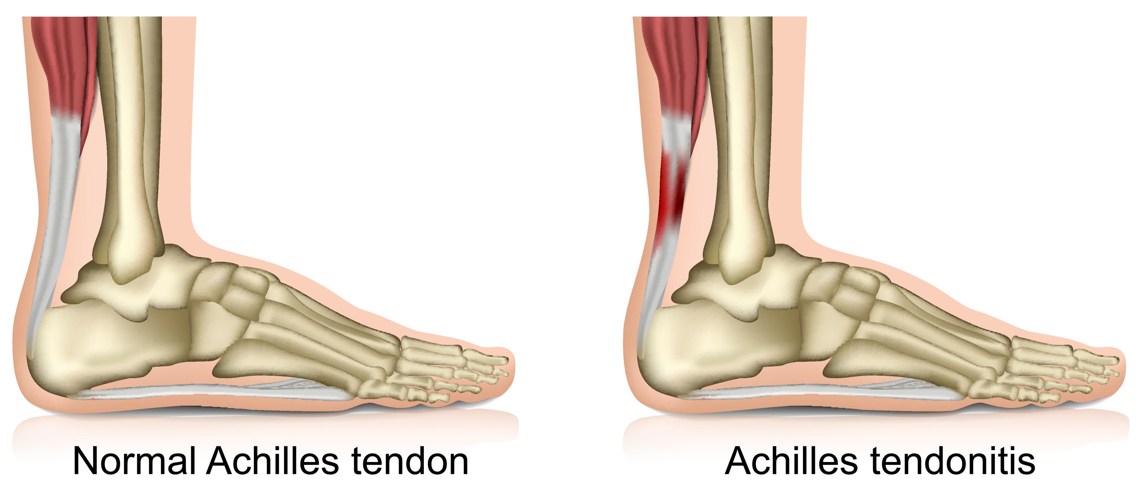 swelling on side of achilles tendon