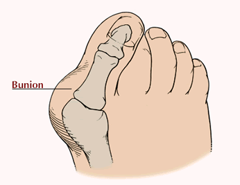 extra bone growth in feet